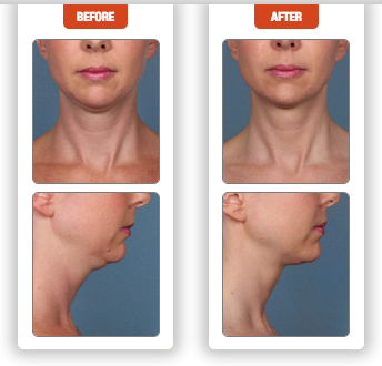 kybella is a non surgical treatment for double chin how kybella works