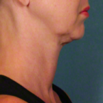 Kybella-before-2092896-2398790