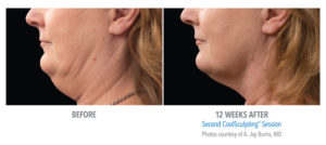 Coolsculpting before and after chin area photo