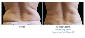 Before and After Coolsculpting Photo