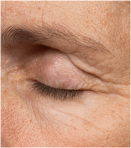 Before Thermage