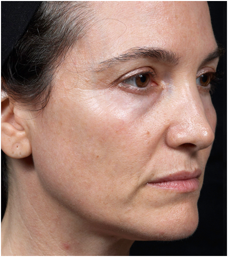After Thermage