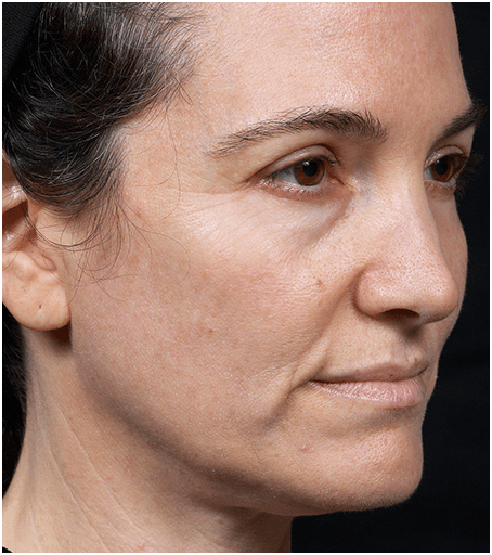Before Thermage