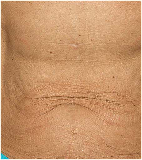 Before Thermage